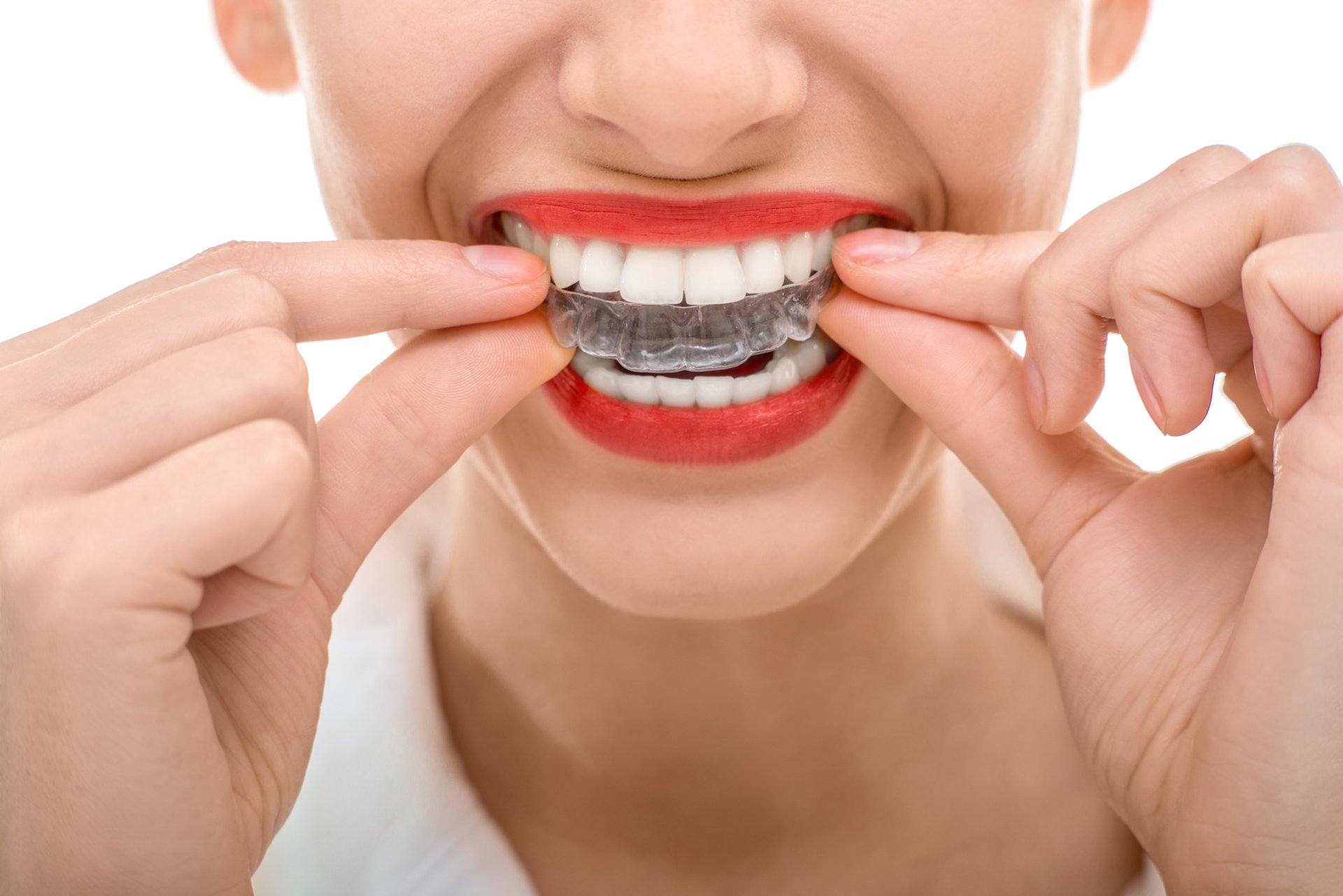 Faccette dentali con denti storti: è possibile? Tecniche e materiali