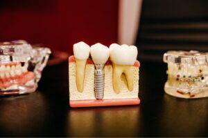 impianti dentali o dentiera